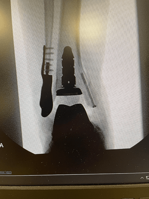 Dave's 3D ankle reconstruction surgery involved creating a 3D printed ankle bone.