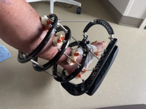 Dave wore an external fixator for his Charcot foot syndrome to keep his foot immobilized which allowed it to fully heal.