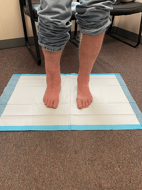 This follow-up visit photo shows how Dave's heels are symmetrical, flat, and straight, thanks to 3D ankle reconstruction surgery.