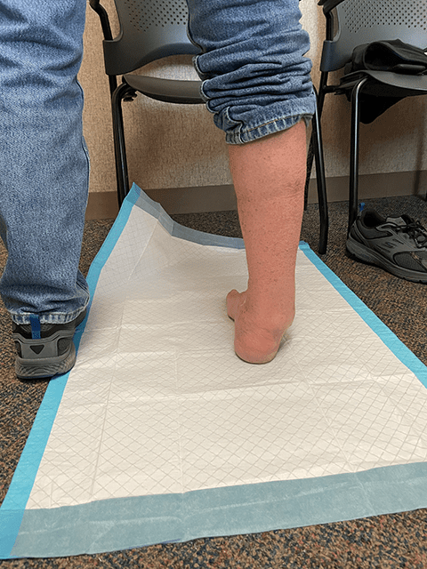 Dave needed ankle reconstruction surgery to finally resolve his ankle pain.